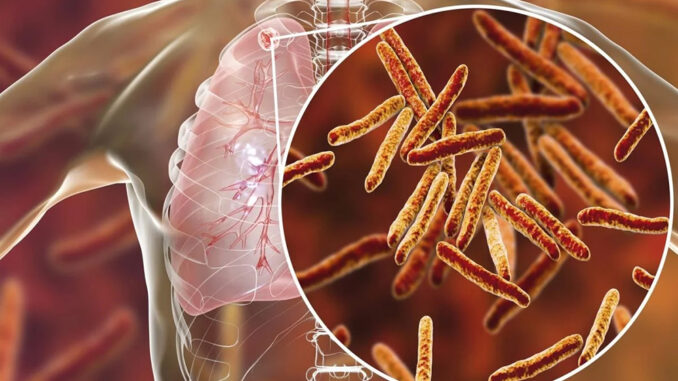 Tuberculosis