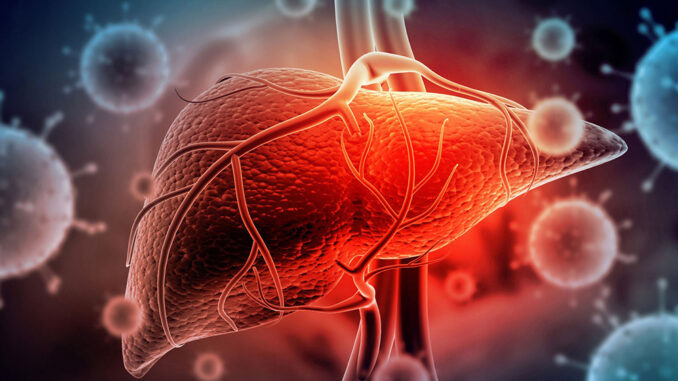 hepatitis