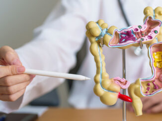 Cáncer de colon