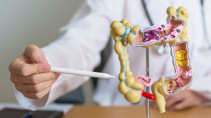 Cáncer de colon Cáncer de colon